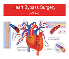 Bypass Surgery Cost at Livasa Mohali - Affordable Heart Care